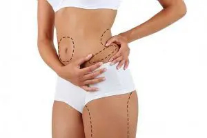 How Liposuction Surgery is Performed: All the Details of the Procedure