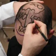 Памятка пациенту перед операцией по пересадке волос