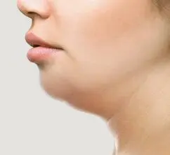 Підтяжка шиї