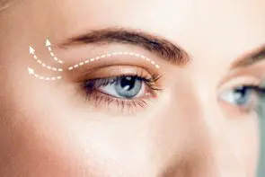 Підтяжка повік