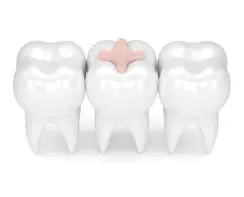 Преимущества и недостатки стоматологических композитных материалов