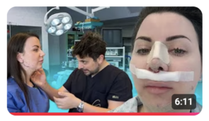 Rhinoplasty in Turkey 