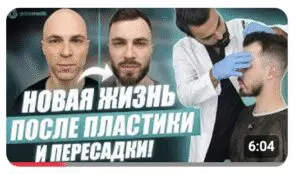 Как прошла мужская пересадка волос в Турции?