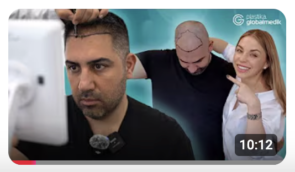 Пересадка волосся в Туреччині при псоріазі 