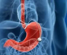 Баріатричні операції