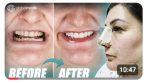 All in one trip: veneers in Turkey + rhinoplasty