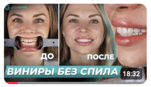 E-max Veneers in Turkey