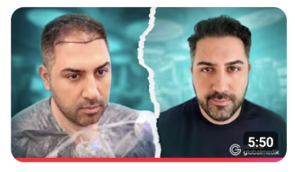 Recovery after hair transplant with psoriasis 