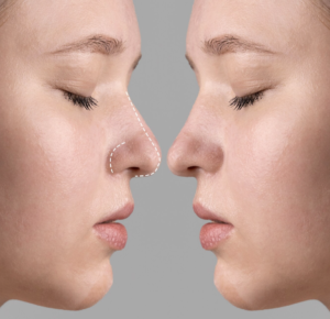 Вторичная ринопластика: когда стоит переделывать нос