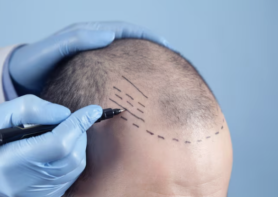 Hair Transplant in Istanbul: How Many Grafts Do You Really Need?