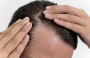 Пересадка волос при псориазе головы и других кожных заболеваниях: подготовка, прогноз