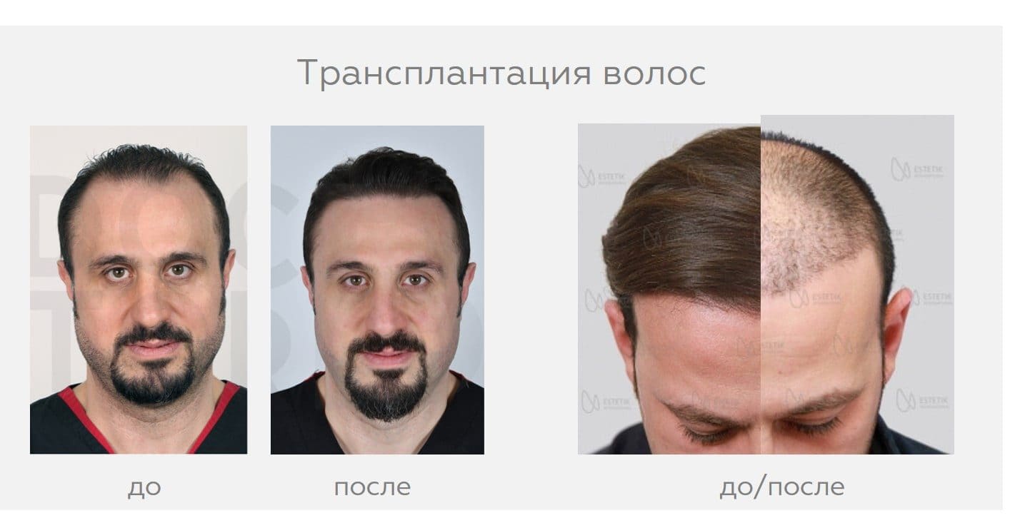 Пересадка волос До и После