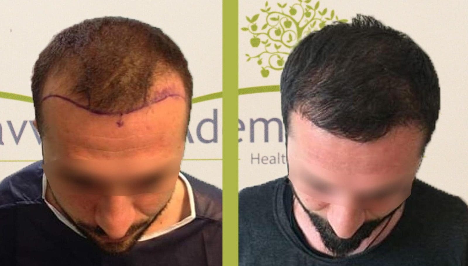 Фото до и после пересадки волос.