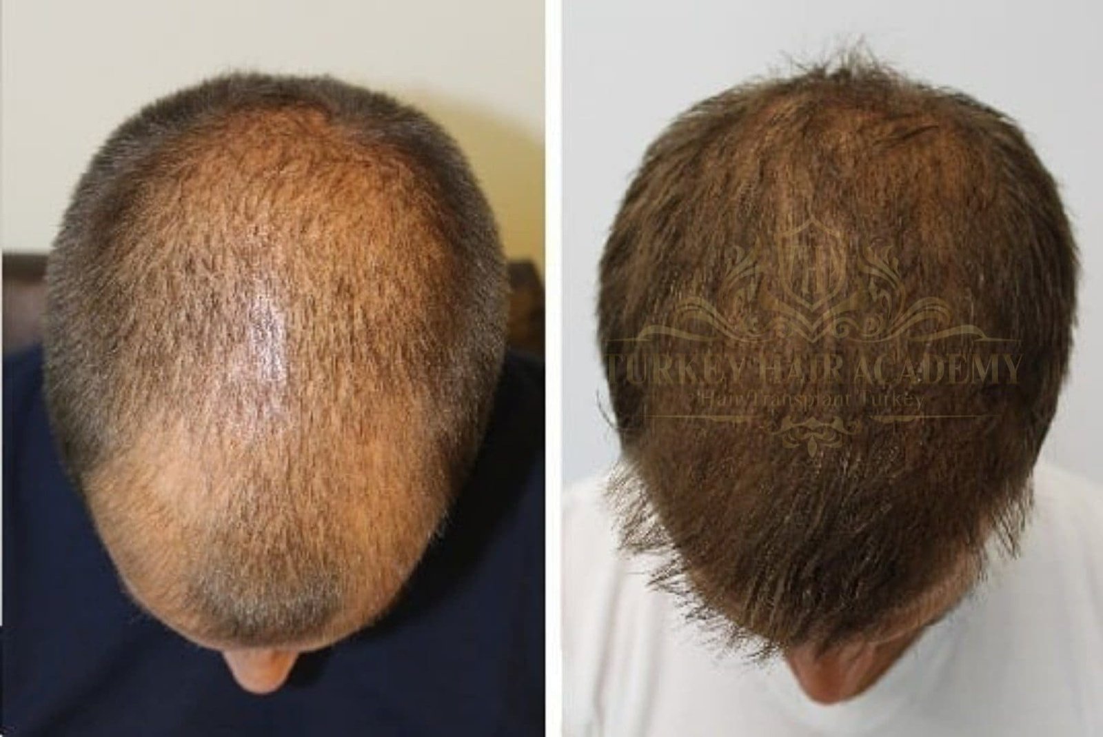 Руслан белый после пересадки волос фото до и после