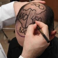 Пам'ятка пацієнтові перед операцією з пересадки волосся