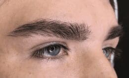 Eyebrow transplant