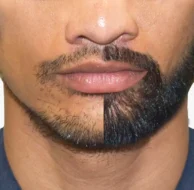 Beard and moustache transplant