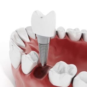 Установка зубних імплантів