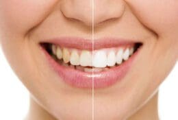 Installation of veneers