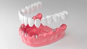 Чем отличается протезирование зубов all-4 и all-6
