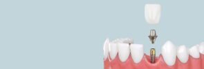 Обзор винтовой фиксации импланта зуба