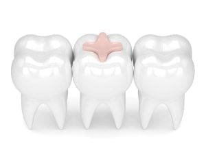 Переваги та недоліки стоматологічних композитних матеріалів