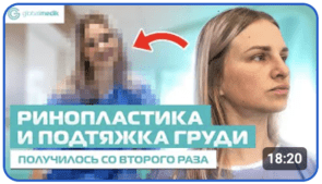 Ринопластика и Подтяжка груди с имплантами