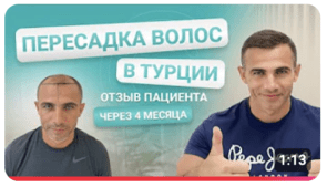Пересадка волос в Турции. Отзыв пациента через 4 месяца