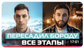 Пересадка бороди у Туреччині.