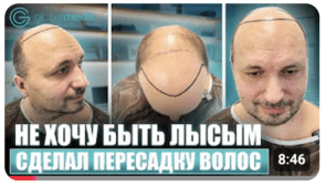 Пересадка волос в Турции | Все о двухэтапной пересадке