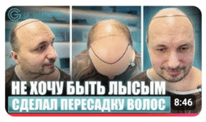 Все о двухэтапной пересадке волос FUE и DHI