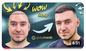 Пересадка волос в Турции