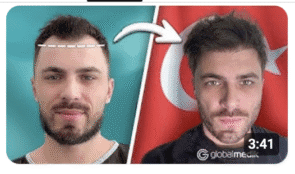 Пересадка волос в Турции с Hair.Globalmedik