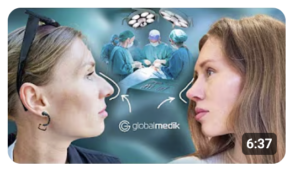 Rhinoplasty in Istanbul: the results after 2.5 Monts