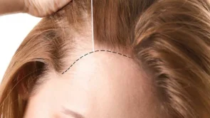 Женская пересадка волос. Как спасти волосы?