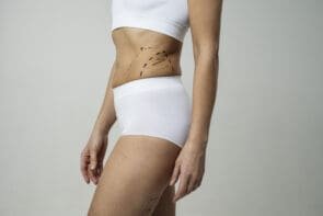 Features of the recovery period after abdominoplasty