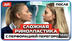 Ринопластика с закрытием перфорации носовой перегородки