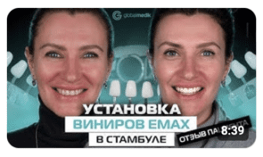 Установка виниров Emax в Стамбуле - отзыв пациента