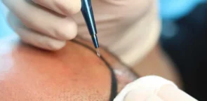 Ручной метод изъятия графтов (Manual Hair Extraction): Революция в трансплантации волос