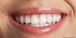 How Long Do Veneers Last and Can They Be Replaced?