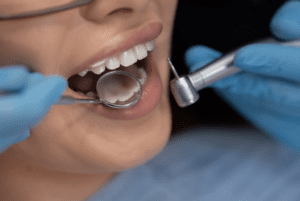 Голливудская улыбка: полный гайд по процедуре